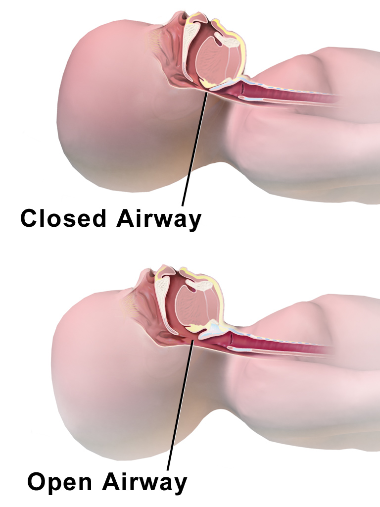 File CPR Infant Closed vs Open Airway.png Wikimedia Commons