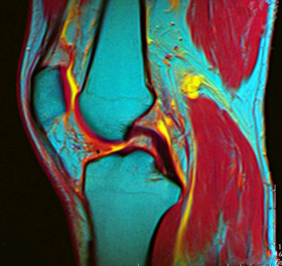 File:Knee MRI 133610 rgbca pdfs t2 t1.png