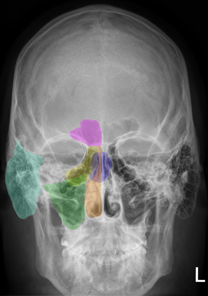 Как выглядит фронтит. Рентген придаточных пазух носа фронтит. Клиновидная пазуха рентген. Лобный синусит рентген.