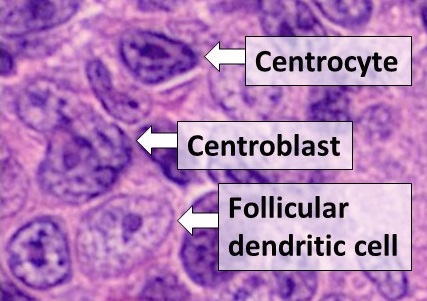 Histologic comparison of cell types in a germinal center, H&E stain: - Centrocytes are small to medium size with angulated, elongated, cleaved, or twisted nuclei. - Centroblasts are larger cells containing vesicular nuclei with one to three basophilic nucleoli apposing the nuclear membrane. - Follicular dendritic cells have round nuclei, centrally located nucleoli, bland and dispersed chromatin, and flattening of adjacent nuclear membrane.