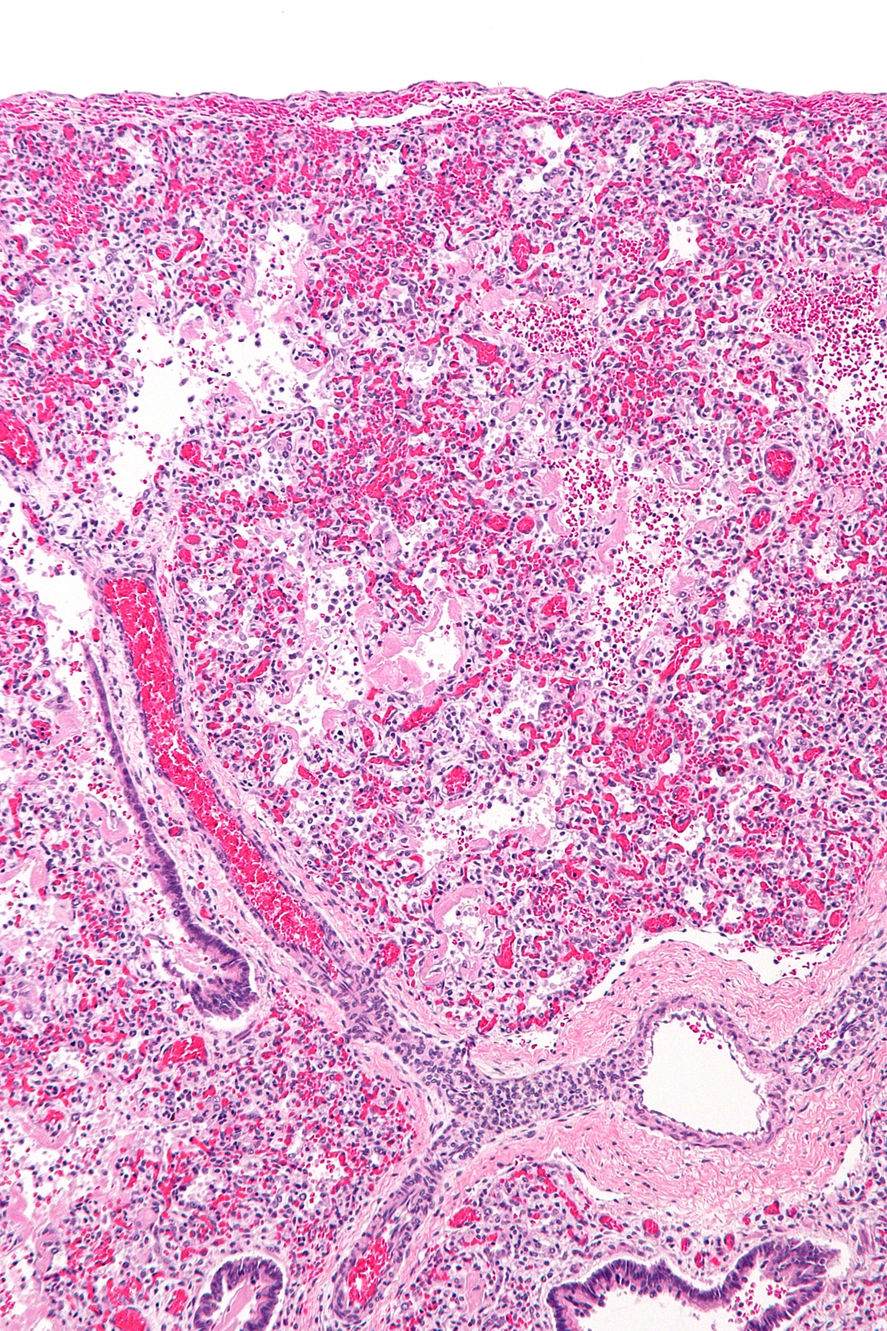 atelectasis histology