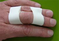 Buddy-taped fingers: the broken finger is taped to the next unbroken finger, with padding, so that it splints it and reduces pain.