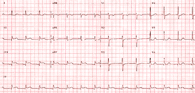 File:ECG1.png