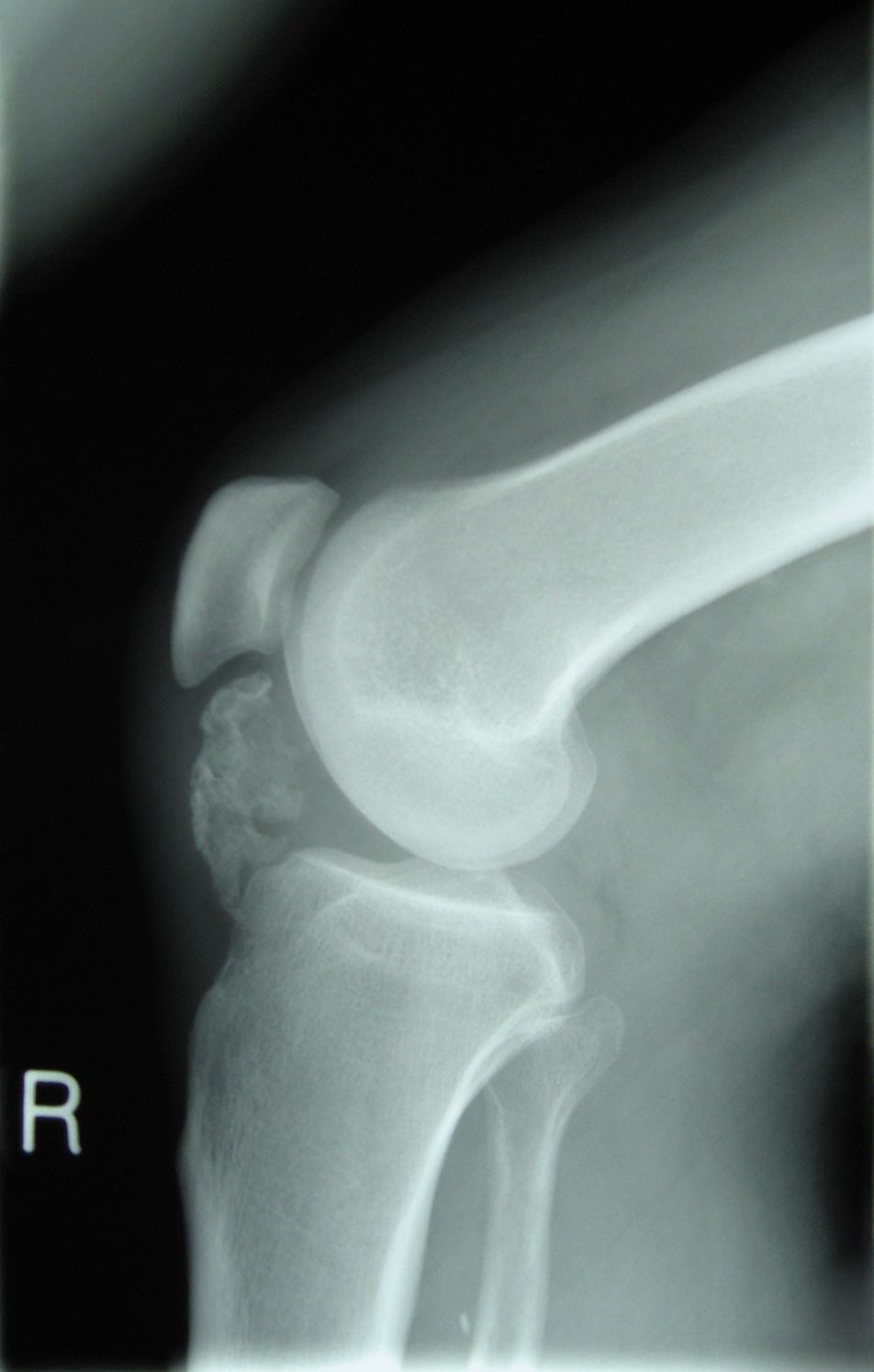 chondroma in knee x ray