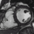 Kernspin einer ARVC mit angeblich fettiger Infiltration des LV und RV