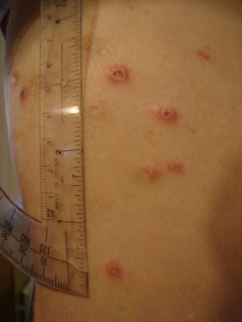 A close-up of small but nasty looking shores on the person's shoulder and upper arm