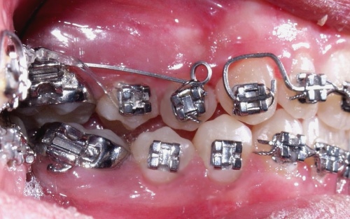 Orthodontics - Wikipedia