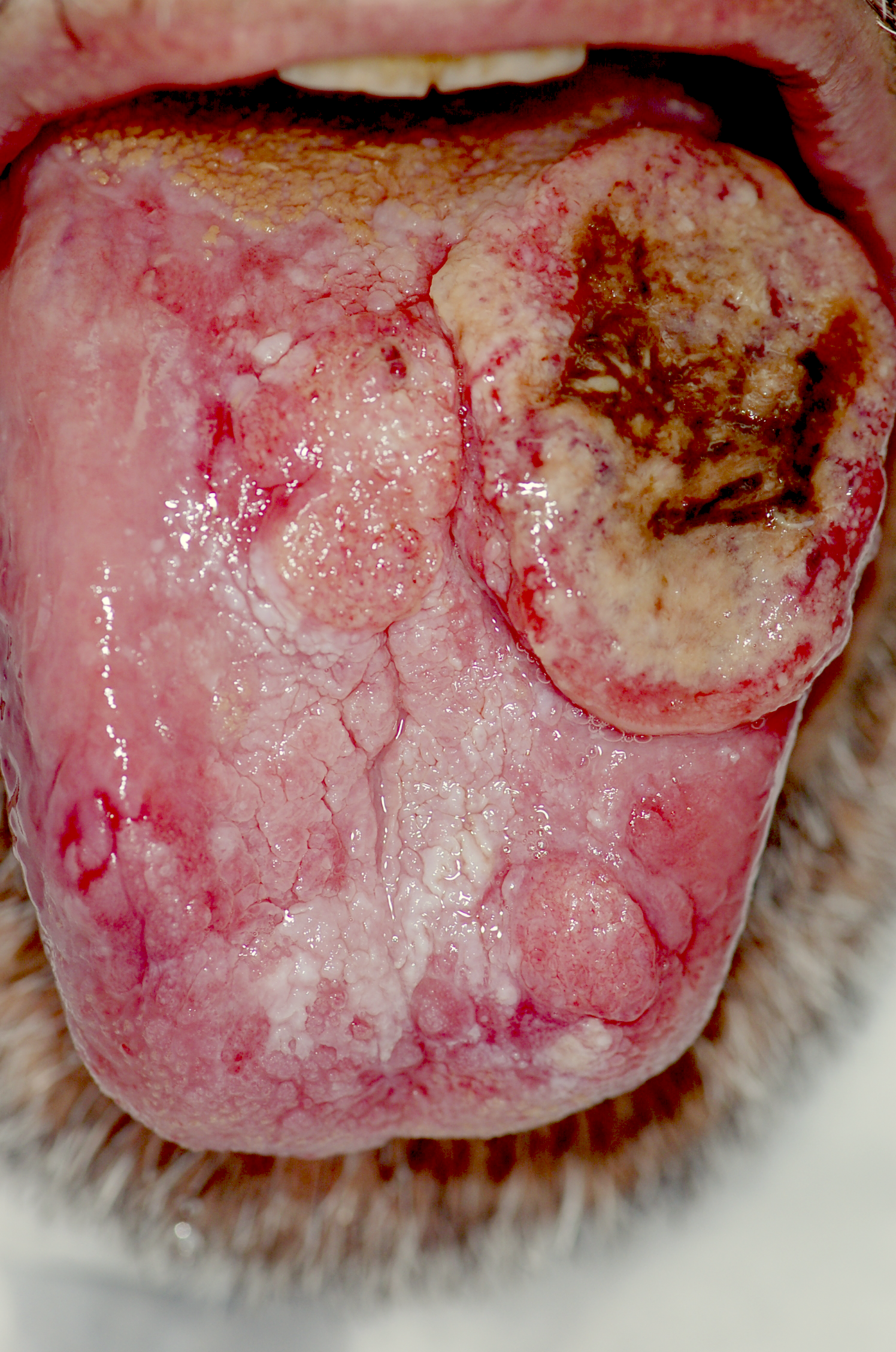 squamous cell carcinoma mouth