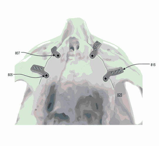 File:Transalveolar dental implant - bottom view.png