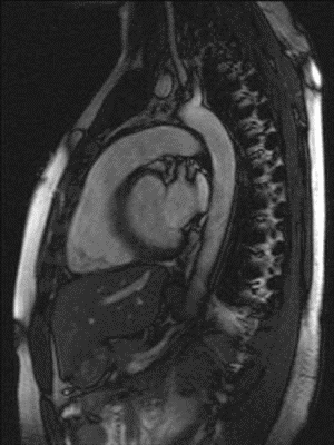 File:Cardiac mri ani sagittal bionerd.gif