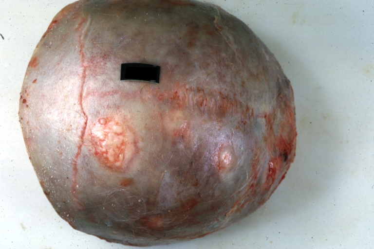 File:Human calvaria with metastatic lesions from primary pancreas carcinoma.jpg