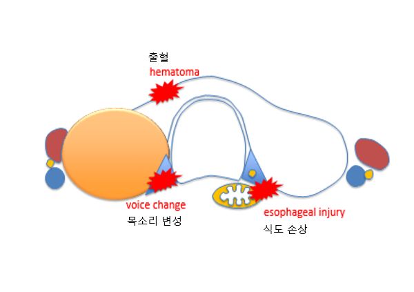 Ablation associated complication