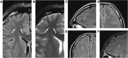 a-f)Diffuse axonal injury on MRI