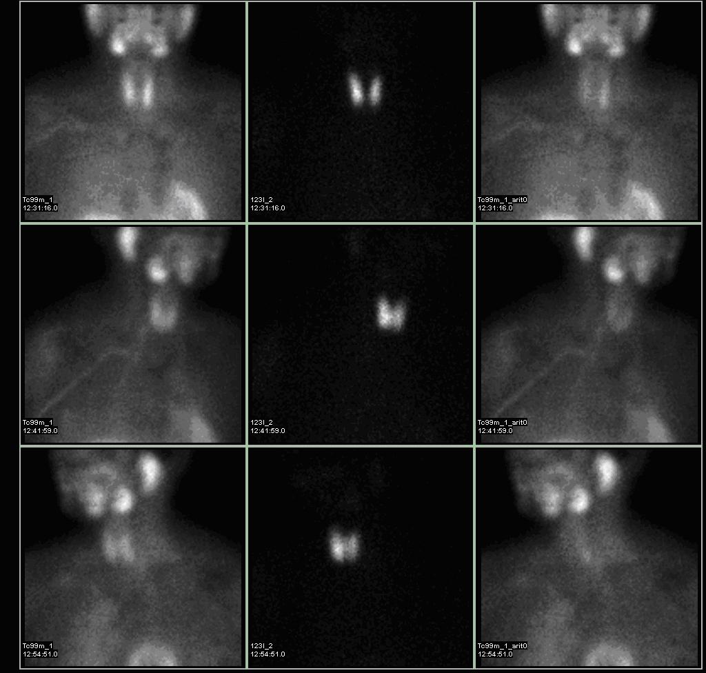 Sestamibi parathyroid scintigraphy