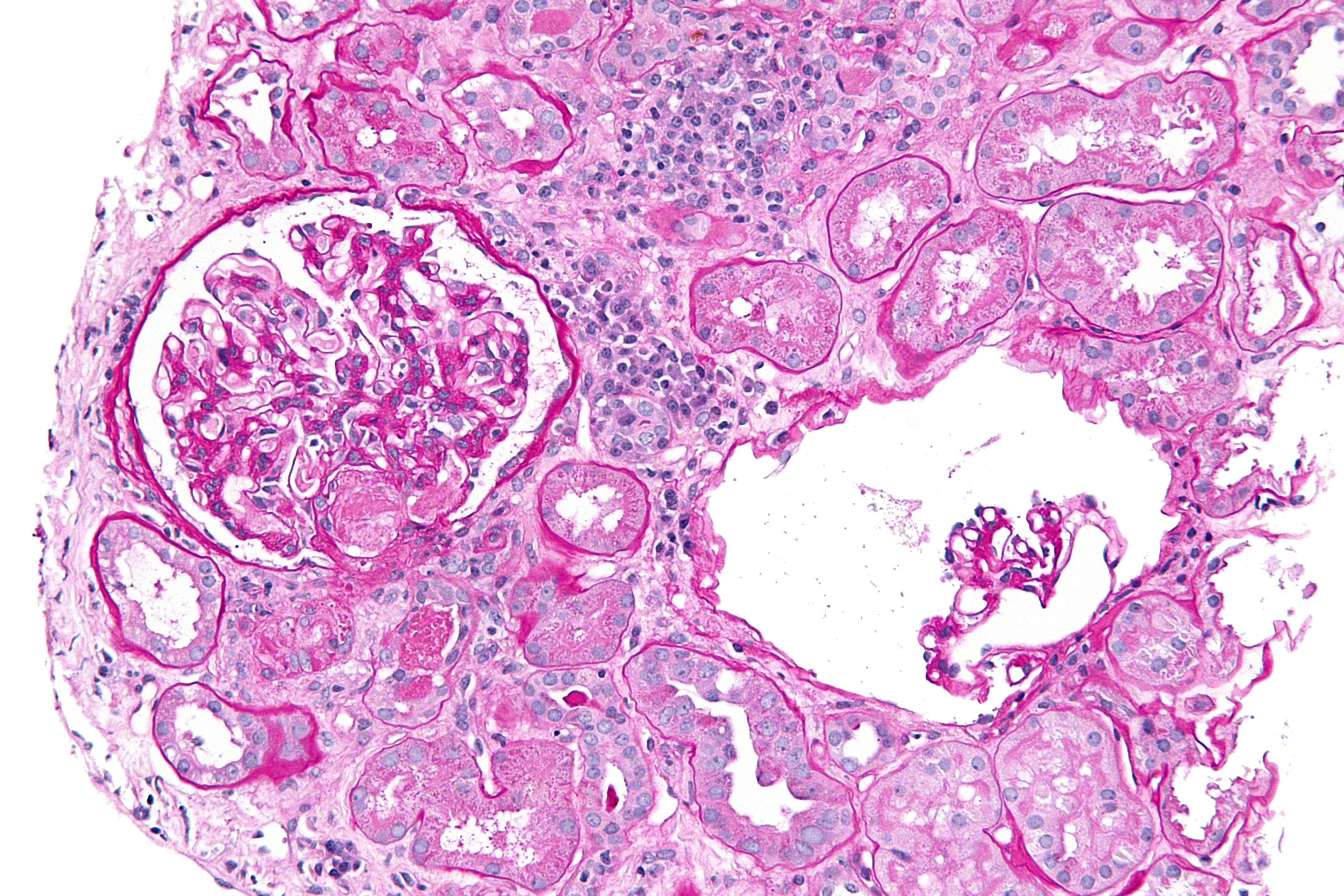 Thrombotic Microangiopathies