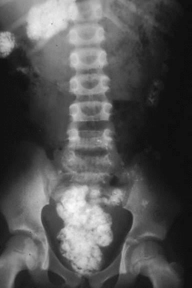 https://upload.wikimedia.org/wikipedia/commons/4/4a/Ascaris_infection_in_X-ray_image-_Pica%2C_the_practice_of_eating_soil_%28South_Africa%29_%2816424840111%29.jpg