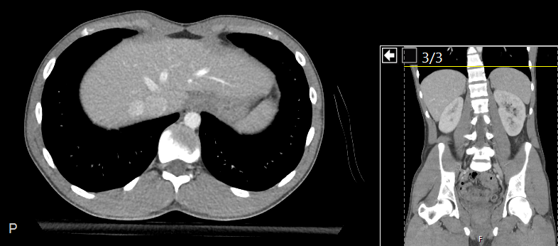 File:CT of a normal abdomen and pelvis, axial plane 33.png