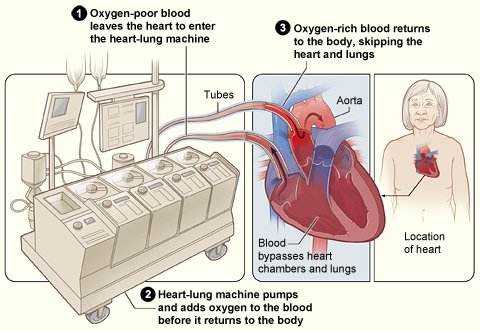Heart-lung bypass