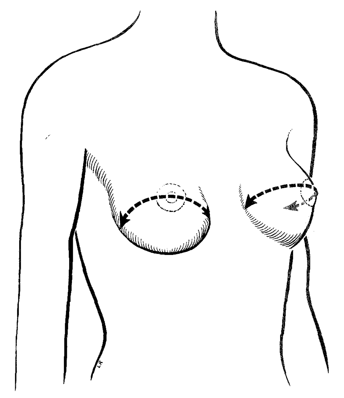 File:Measurement of breast hemicircumference.png - Wikipedia