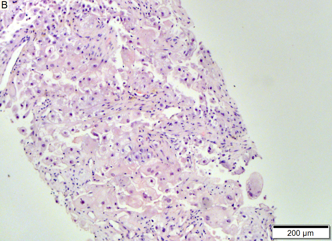 Metastasis of renal cell carcinoma to liver