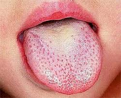 Scarlet fever - Wikipedia