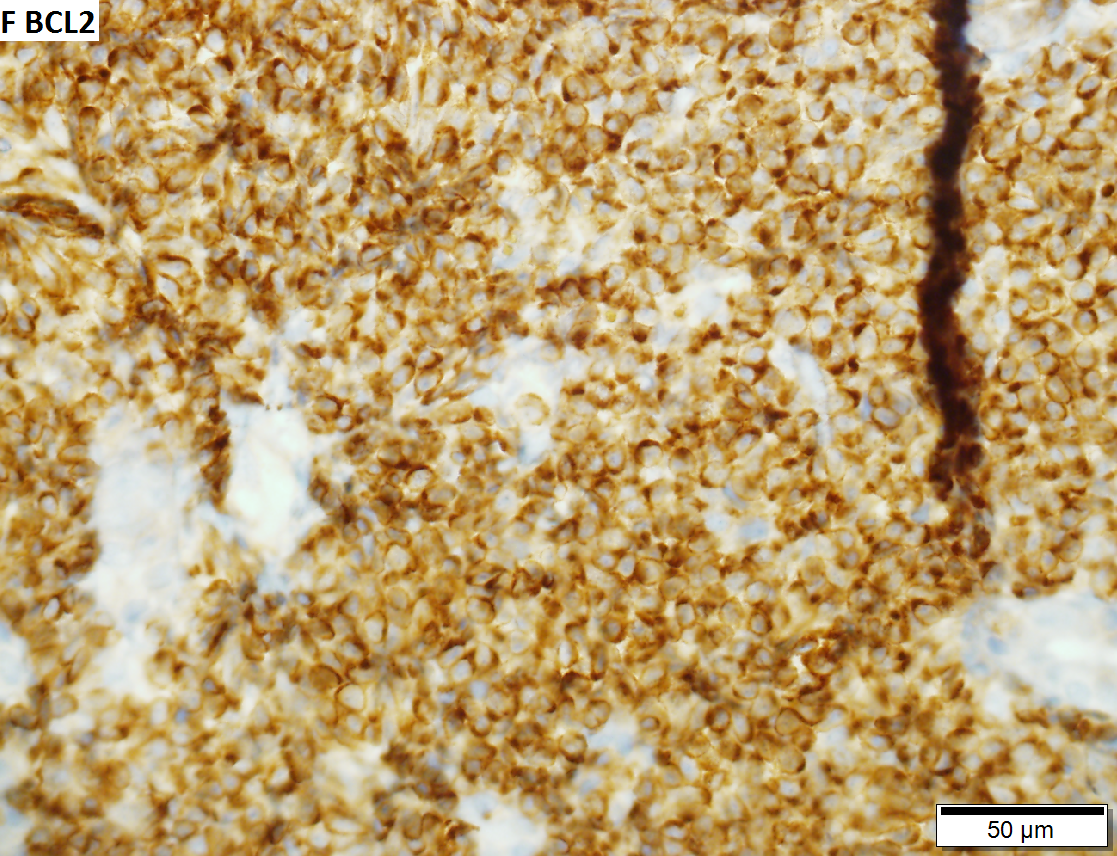 Malignant B cell lymphoma, NOS, in a 63 year old man’s liver