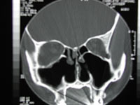 <span class="mw-page-title-main">Turbinectomy</span> Surgical removal of the turbinate bones in the nasal passage