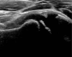 File:Ultrasonography of flattening of the femoral head in Perthes disease.jpg