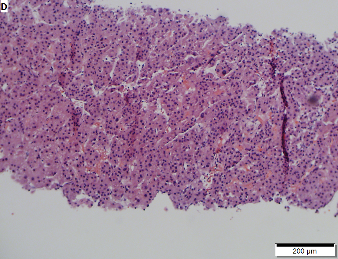 Hepatocellular carcinoma arising in cirrhosis
