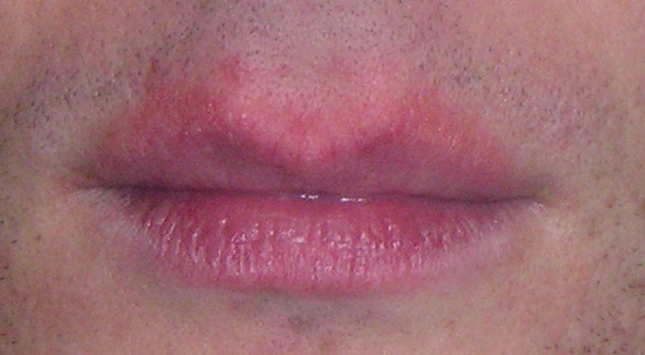 Chapped Lips and Erythema - Treato