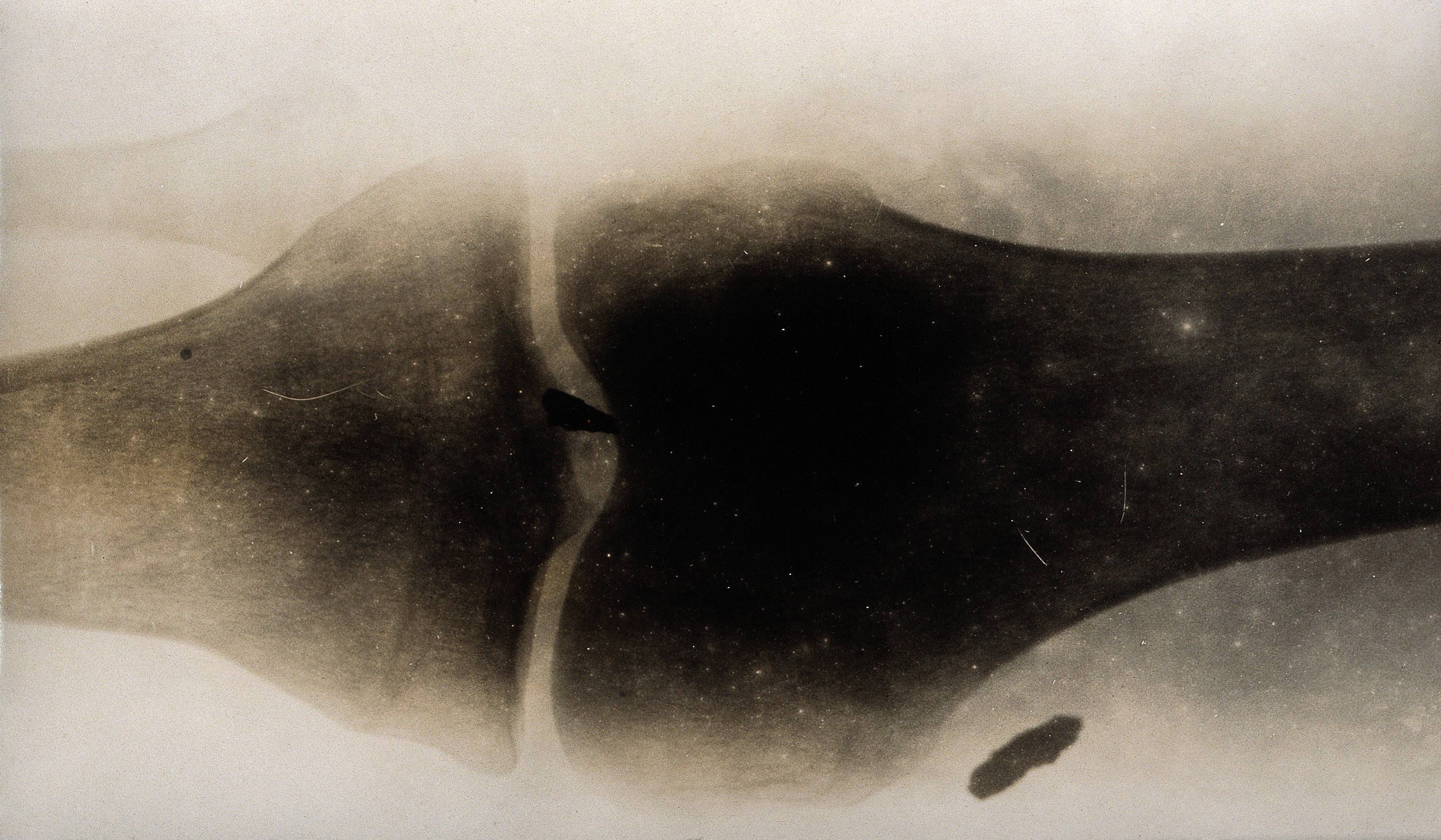 X-ray showing shrapnel lodged in a leg probably of a wounded Allied soldier, c. 1915.