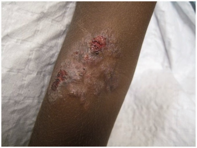 File:10.1177 0956462414549036-fig5-Secondary yaws- maculo-papular lesions with scaling.jpg