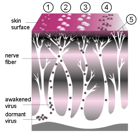 Progression of shingles. A cluster of small bumps (1) turns into blisters (2). The blisters fill with lymph, break open (3), crust over (4), and finally disappear. Postherpetic neuralgia can sometimes occur due to nerve damage (5),