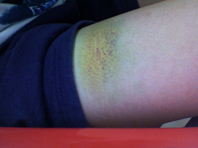 File:Bruise.jpg - Wikipedia