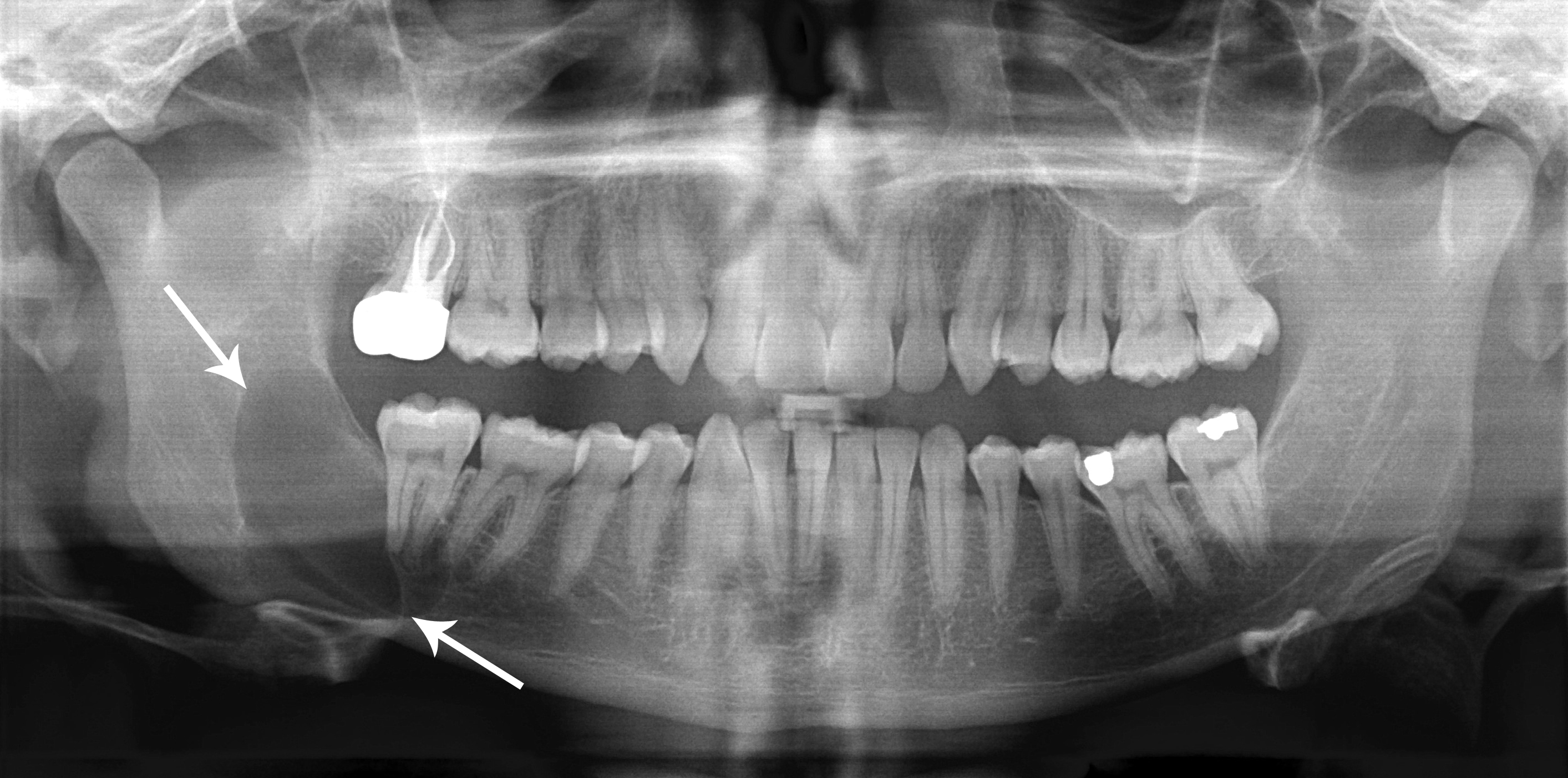 File:Classic keratocystic odontogenic tumour.jpg - Wikimedia Commons