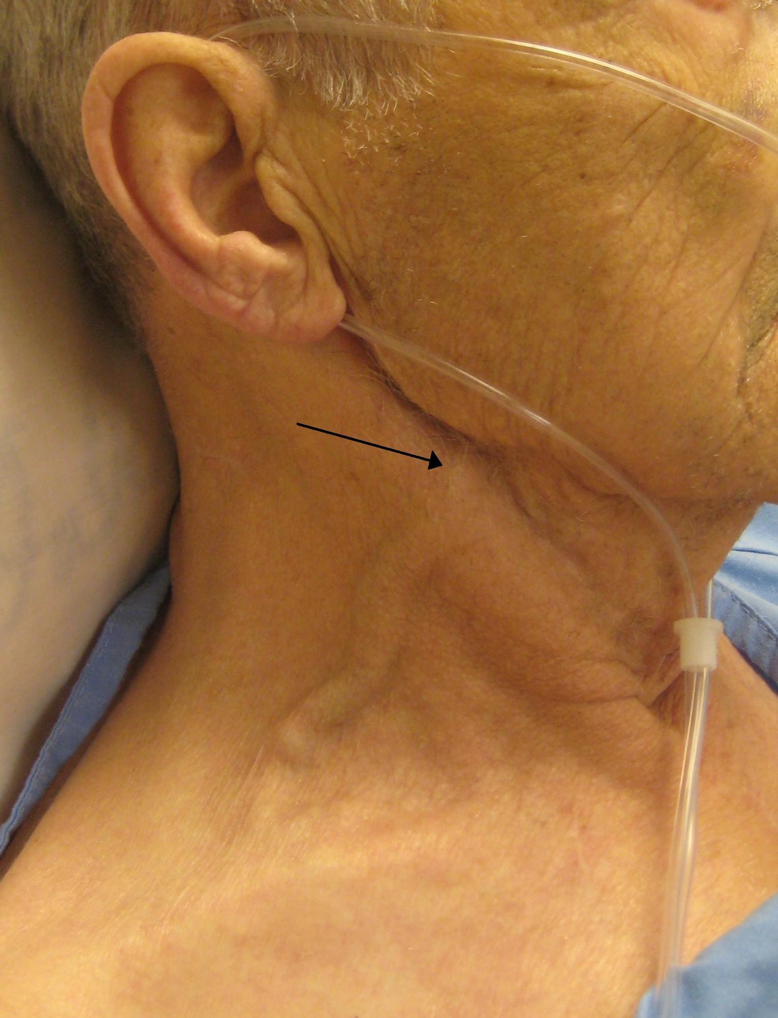 carotid versus jugular venous distention