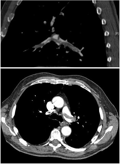 File:Pulmonary embolism CTPA.JPEG