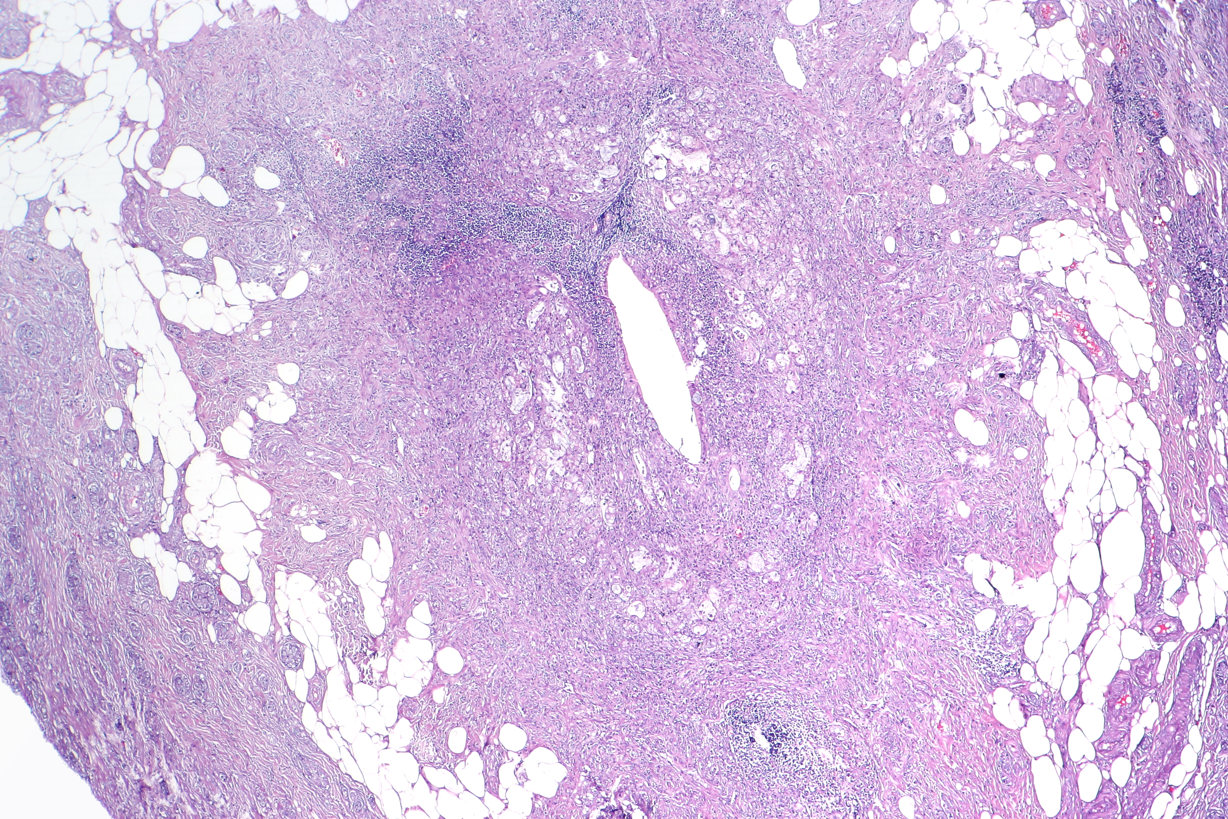 Signet ring cell carcinoma - Wikipedia