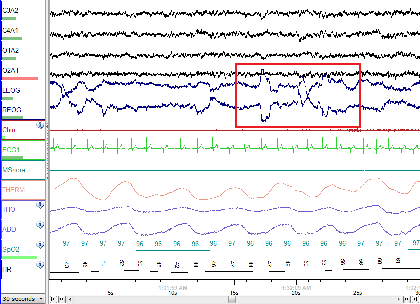 Sleep Study Chart