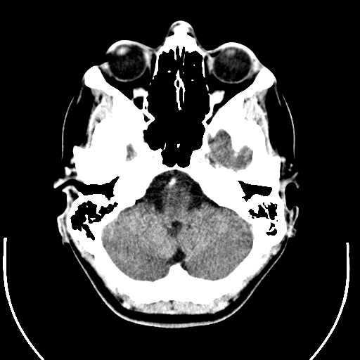 Computed tomography of human brain (5).png