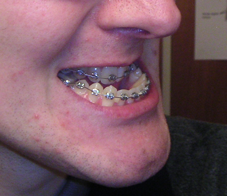 File:Mandibular prognathism pre-surgery.png