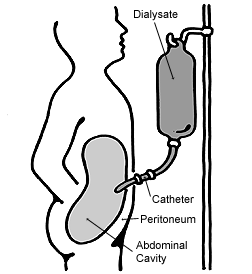 <span class="mw-page-title-main">Peritoneal dialysis</span> Type of dialysis