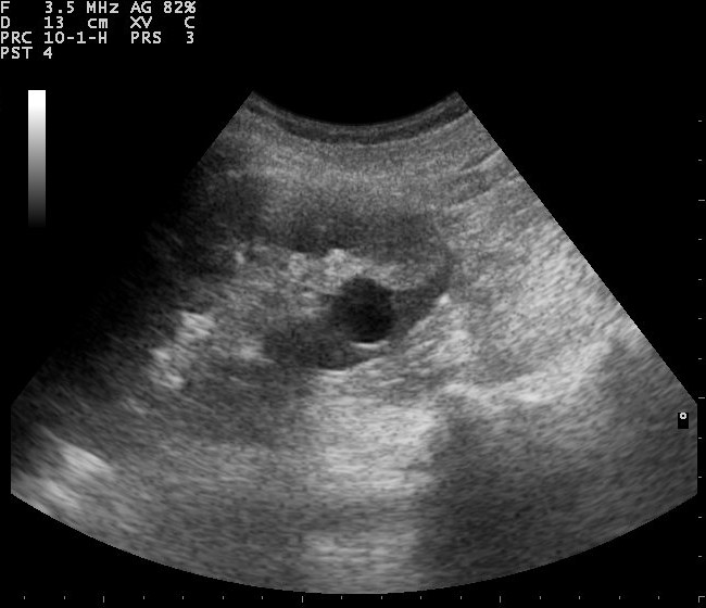 renal cyst ultrasound