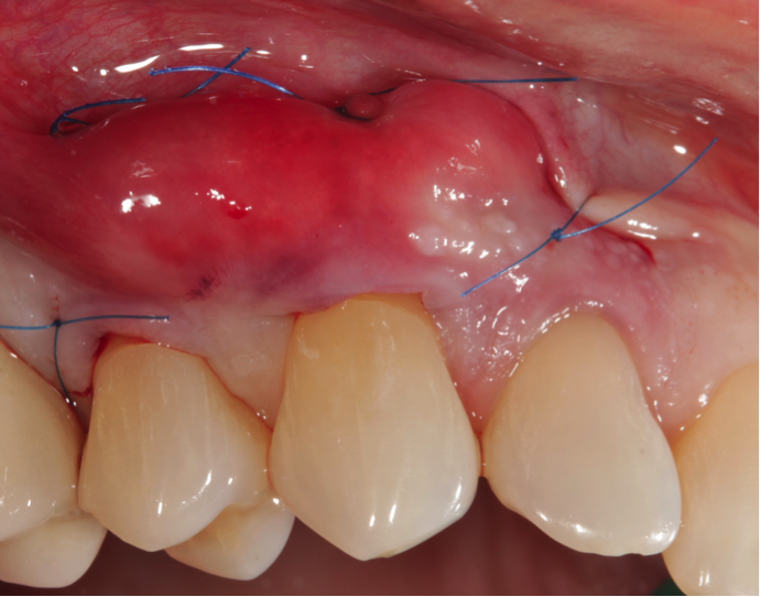 wisdom teeth sutures