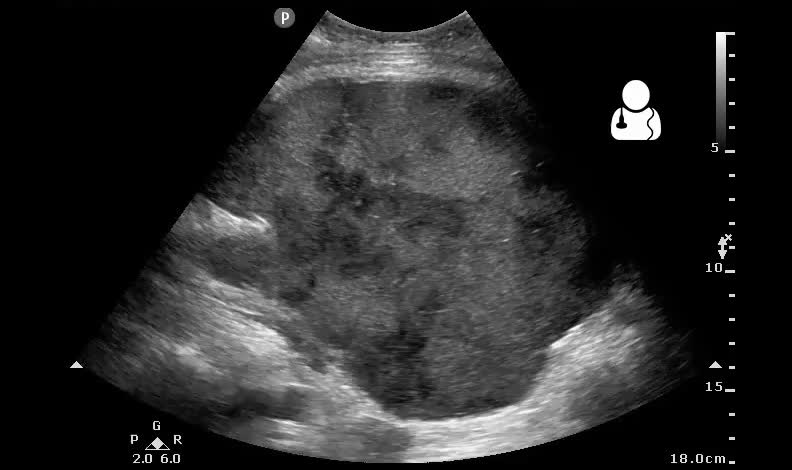 Postoperative bleeding following kidney transplant as seen on ultrasound[80]