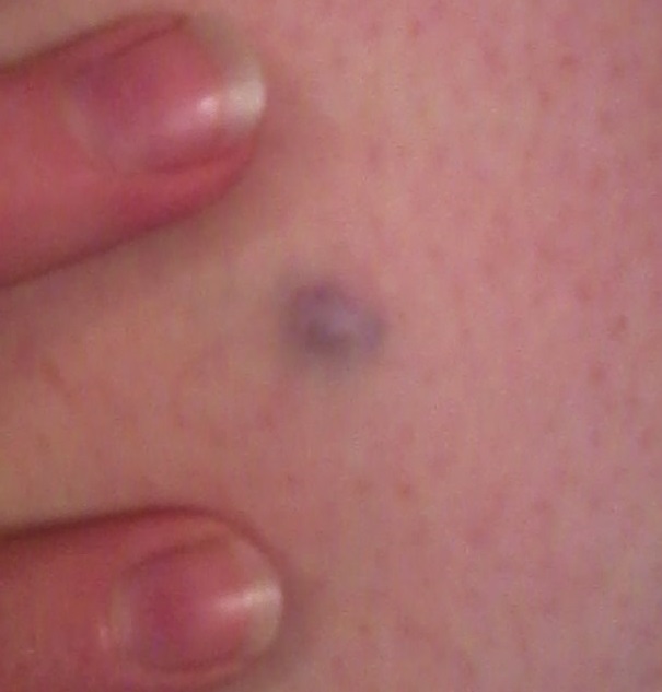 Blue Nevus - American Osteopathic College of Dermatology (AOCD)