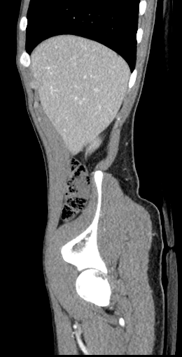 CT of a normal abdomen and pelvis, sagittal plane 39.png