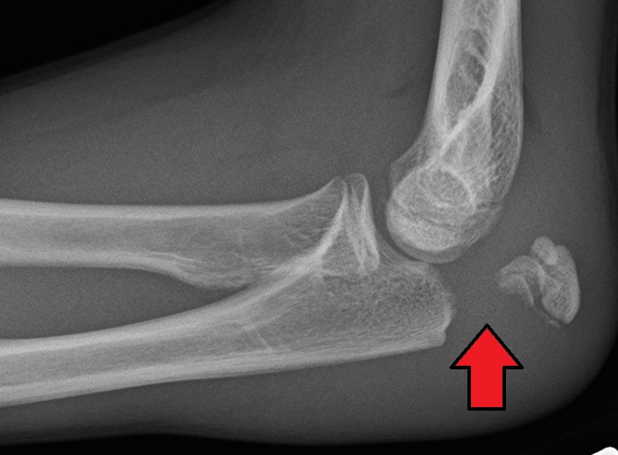 Olecranon fracture Wikipedia