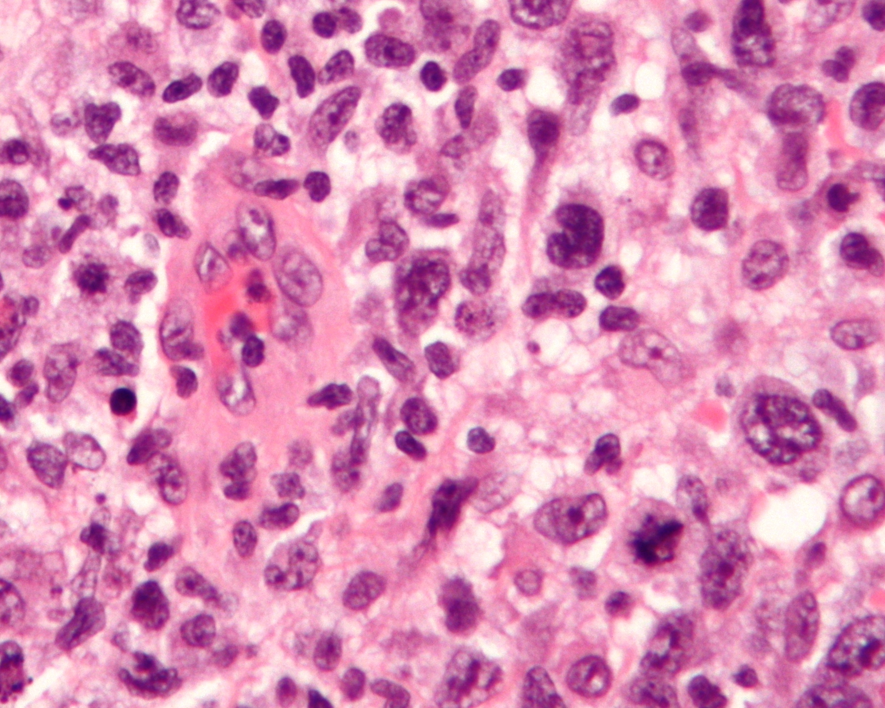 anaplastic carcinoma