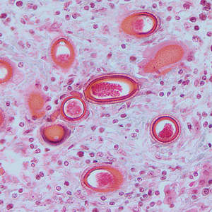 File:Capillaria hepatica tissue HB.jpg